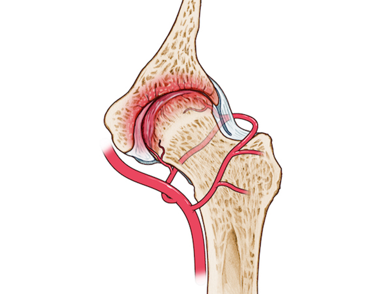 FEMORAL HEAD NECROSIS